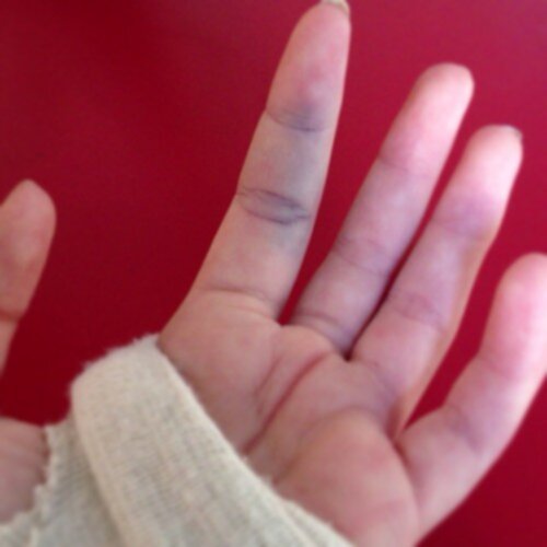 spricka i finger spricka i finger